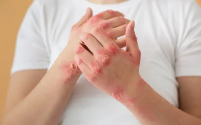 Problèmes de Peau : Adieu Rougeurs et Inconfort !