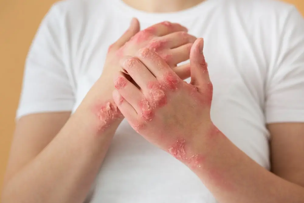 Problèmes de Peau : Adieu Rougeurs et Inconfort !