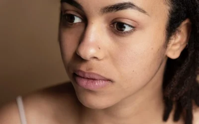 Comment Gérer l’Hyperpigmentation sur Peau Noire et Métisse